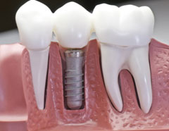 Dental Implant Training Services